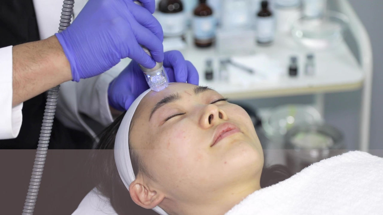 Professional microneedling treatment performed with BENEV Exosome Regenerative Complex
