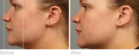 BENEV Exosome Regenerative Complex before and after facial profile