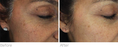 BENEV Exosome Regenerative Complex before and after cheek appearance