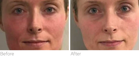 BENEV Exosome Regenerative Complex before and after facial redness