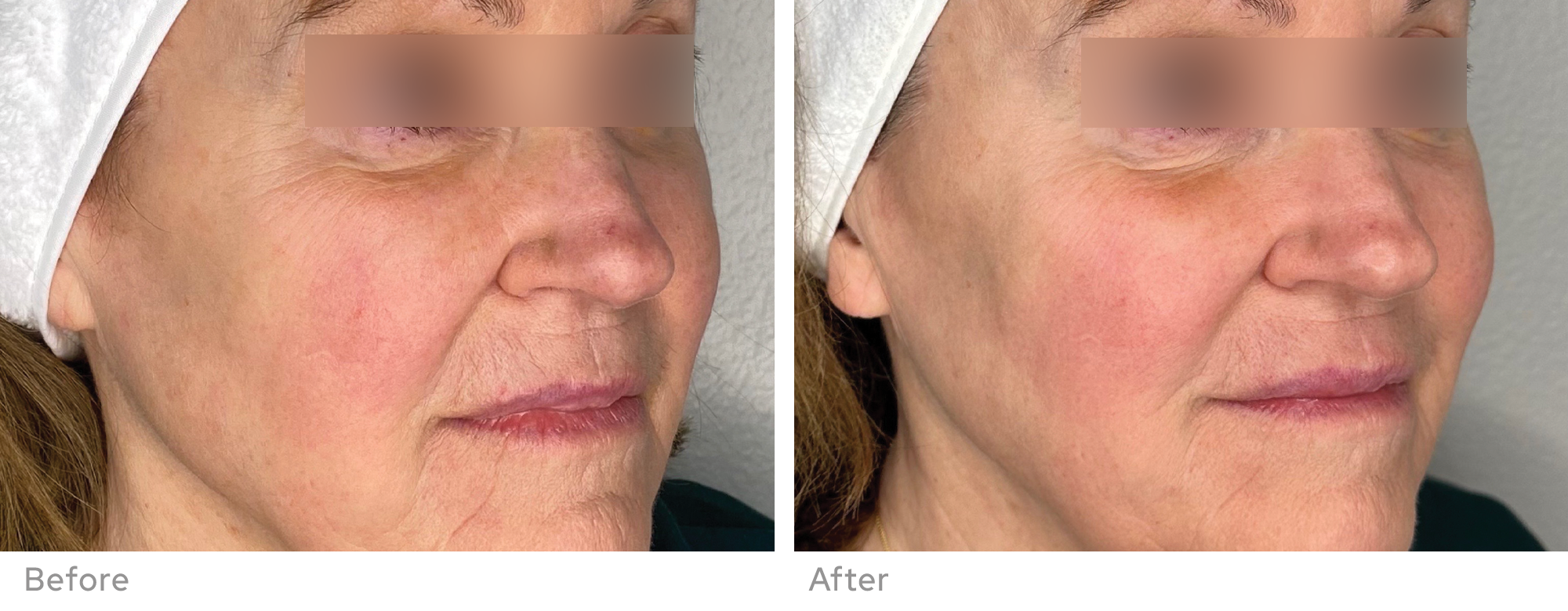BENEV Exosome Regenerative Complex before and after facial rejuvenation
