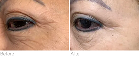 BENEV Exosome Regenerative Complex before and after eye-area appearance