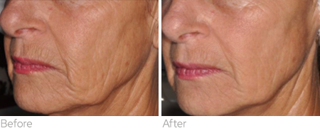 BENEV Exosome Regenerative Complex before and after lower-face appearance