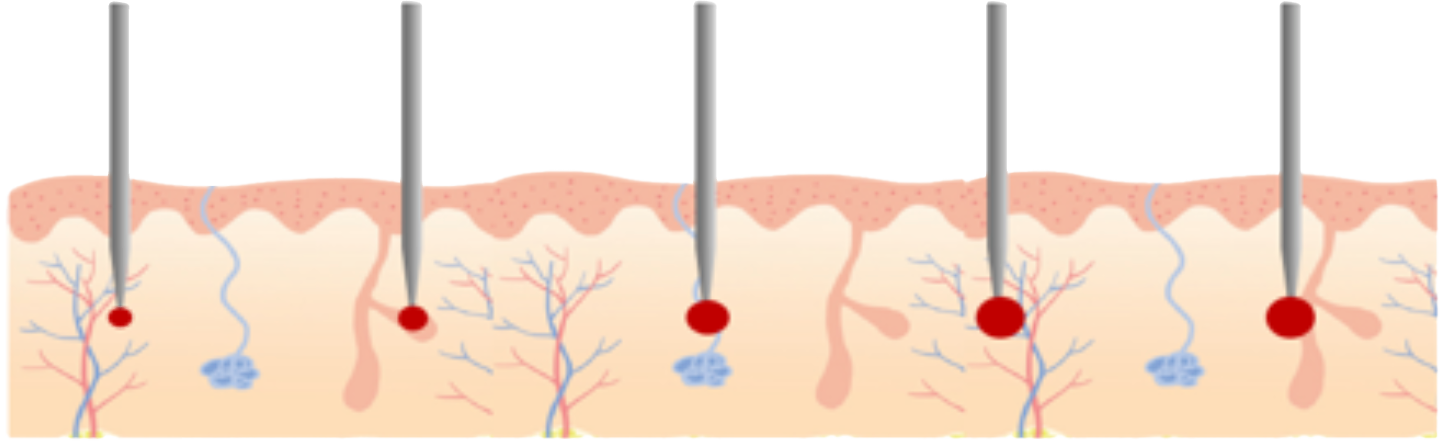 BENEV illustration of localized treatment zones at insulated electrode tips