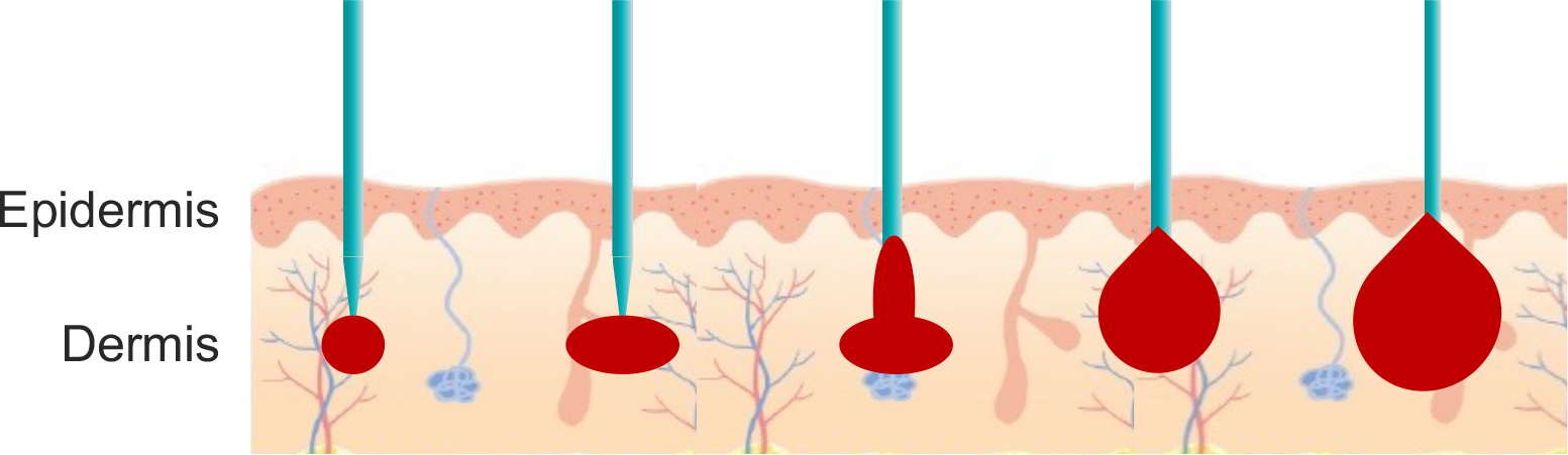 BENEV illustration of treatment zones around non-insulated electrodes
