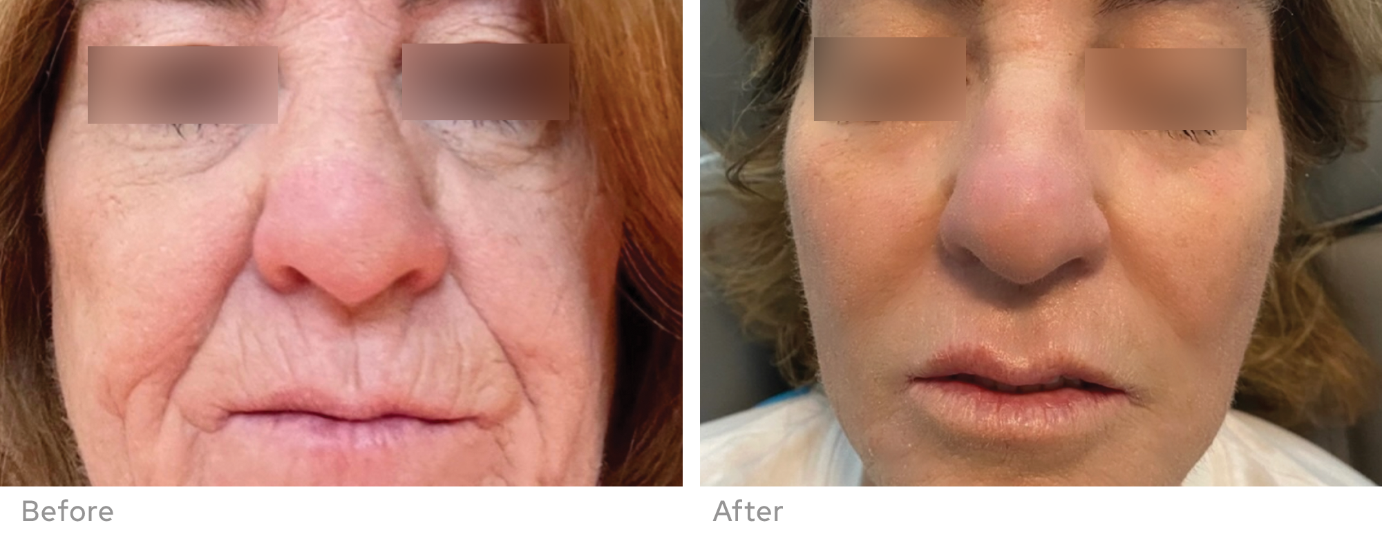 Sylfirm X before and after result showing facial skin appearance