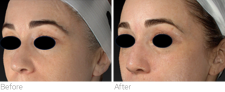Sylfirm X before and after result showing facial tone