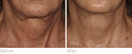 Sylfirm X before and after result showing neck skin appearance