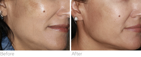 Sylfirm X before and after result showing cheek skin appearance