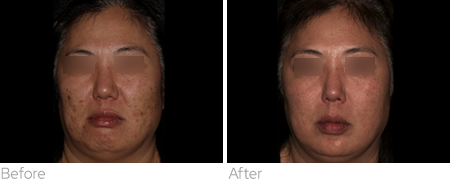 Sylfirm X before and after result showing facial skin appearance